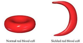 anemia sel sabit