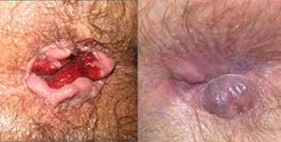 Foto Selain Ambeven, Obat Yang Manjur Buat Ambeyen Dalam Apa? Kapsul Ambejoss