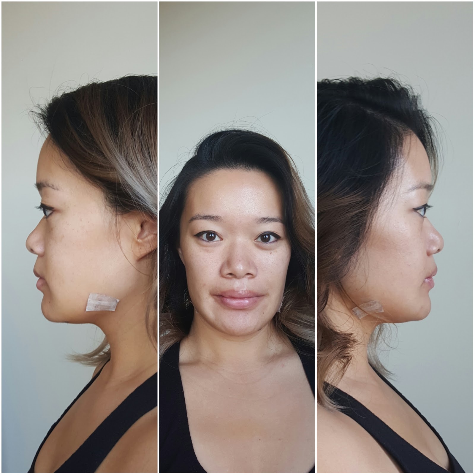 Tina's Double Jaw Surgery Day 15 2nd PostOp Appointment