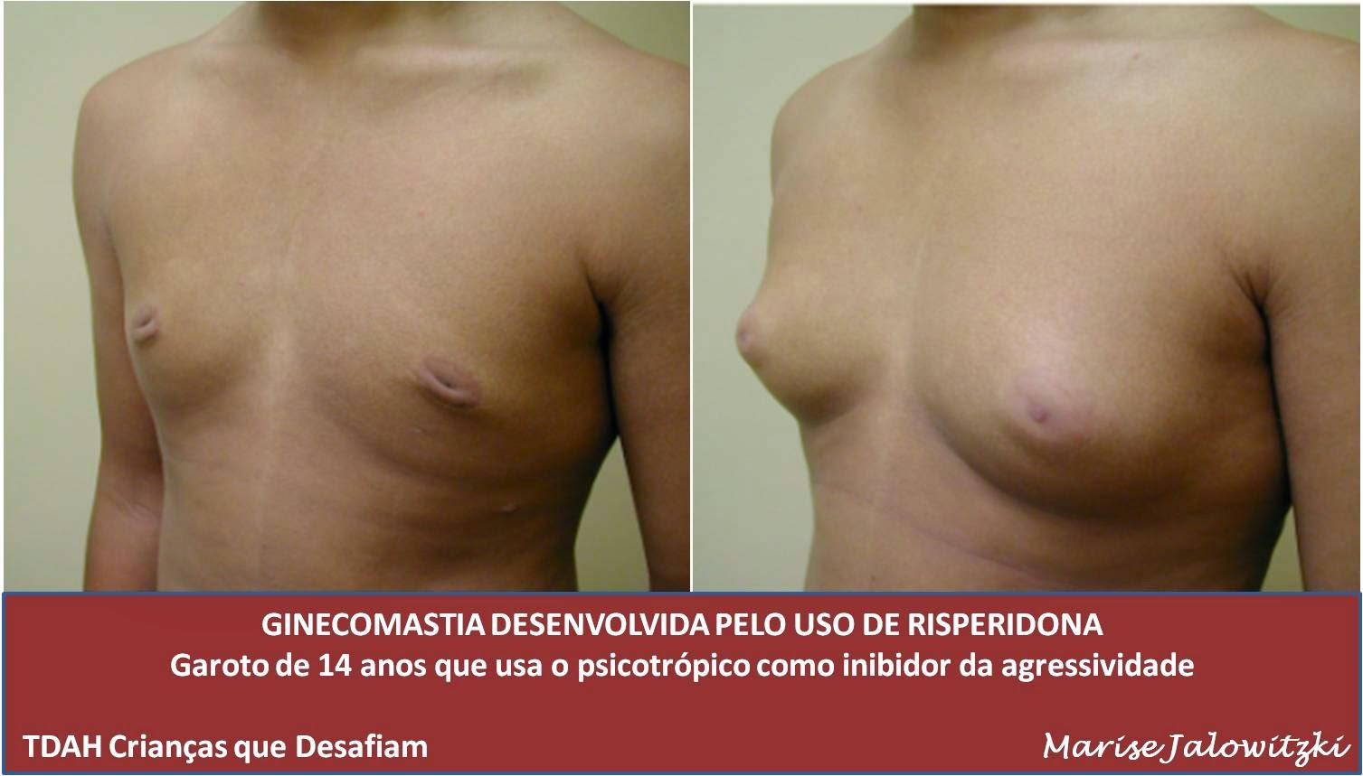 Gynecomastia adolescente -Efeitos colaterais- Risperidona e crescimento de mamas - Clique na imagem