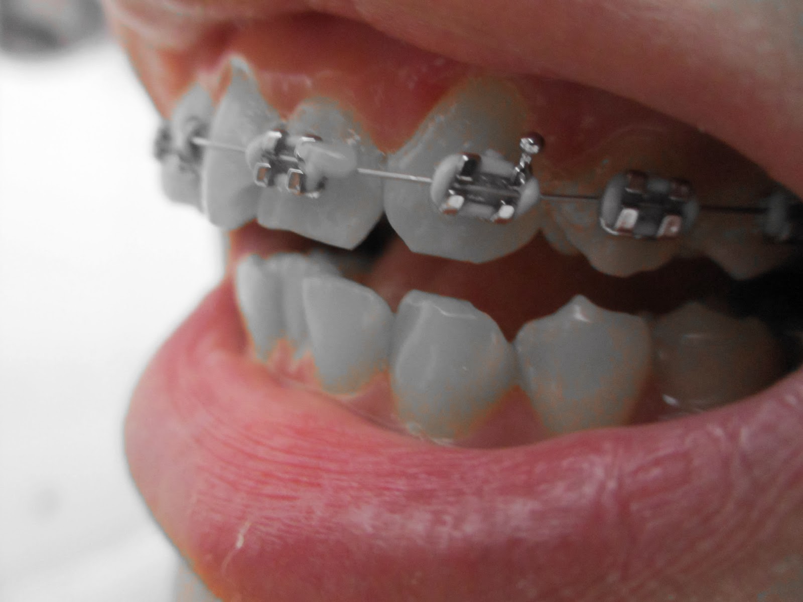 Dear you. 5th Appointment Bottom Braces, Cleaning & Polishing