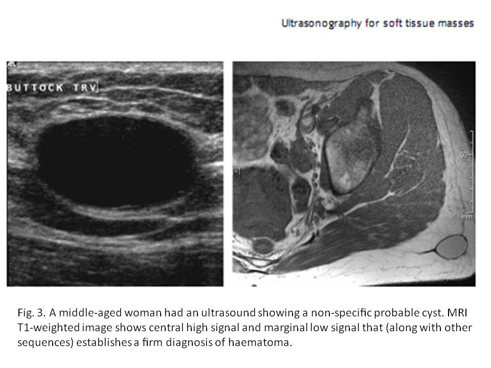 BÀI SOẠN VỀ SIÊU ÂM CHẨN ĐOÁN PITFALLS of ULTRASOUND on SOFT TISSUE MASSES