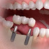  Cấy ghép Implant gắn răng liền là gì?