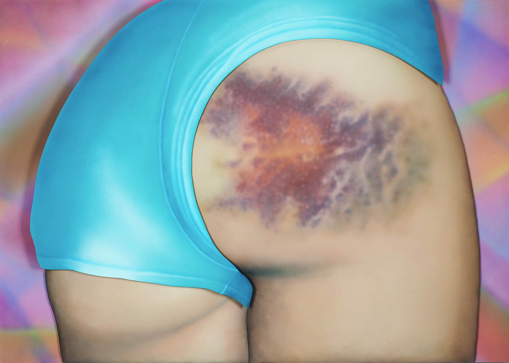 I Got a Really Beautiful Bruise on My Bum, Do You Want To See a Pic? It Has 12 Colours And Is the Size of My Head! - Riikka Hyvönen - Atomlabor Blog