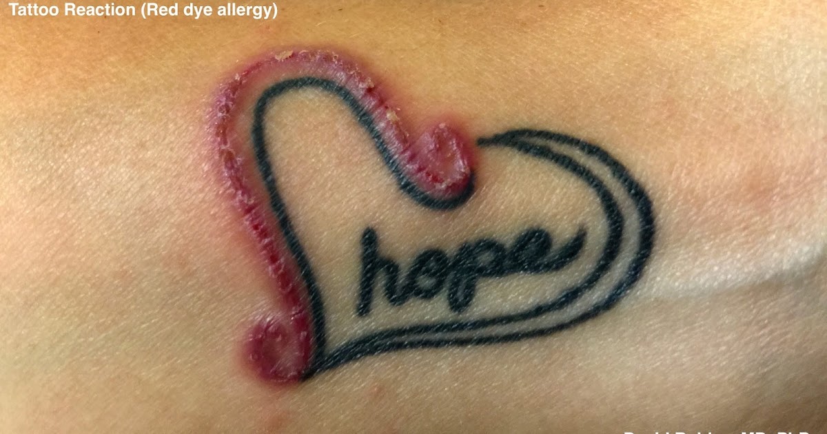 Tattoo Reactions Allergic Contact Dermatitis By David Robles, MD, PhD