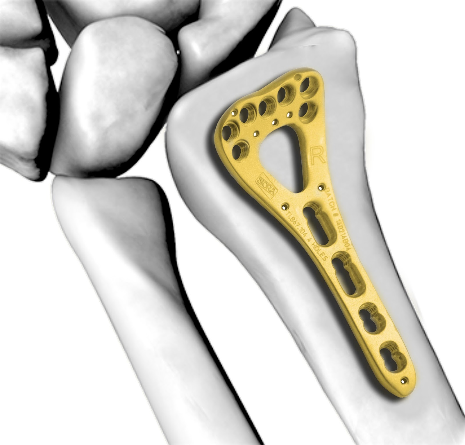 Orthopedic Implants Manufacturer Adding Gold to Titanium Enhances Orthopedic Implants