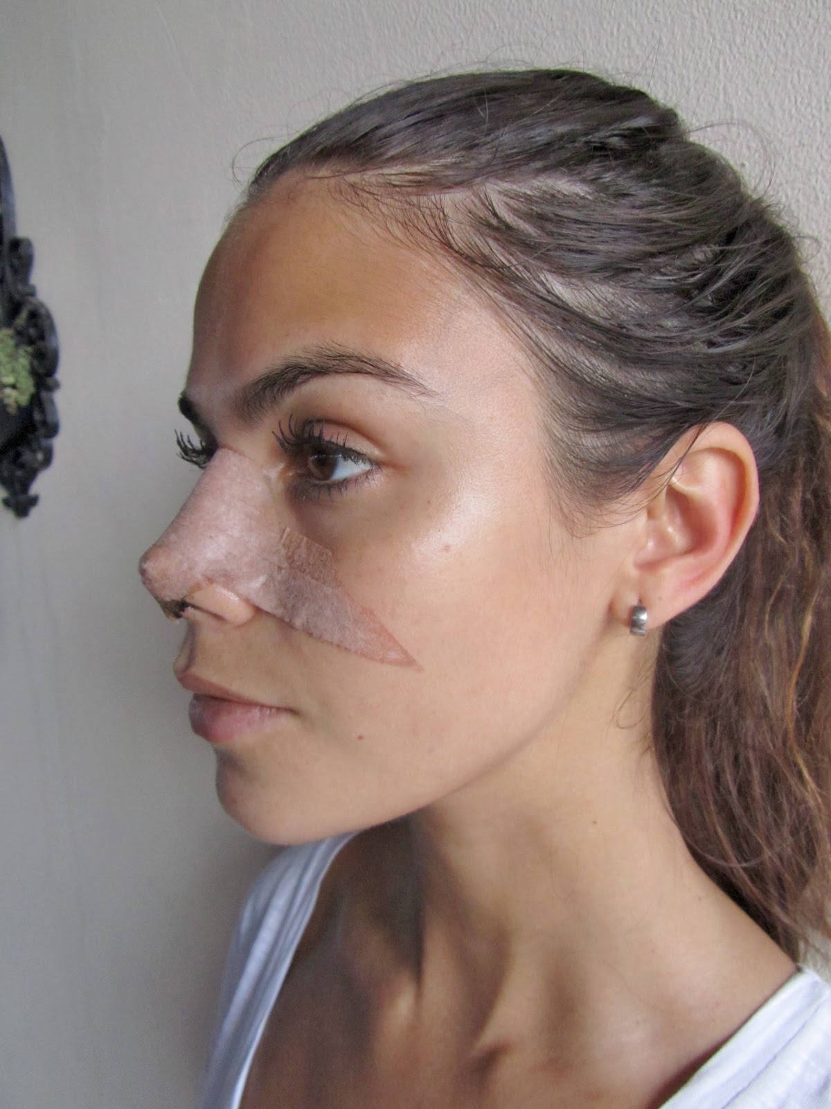 Rinoplastia Antes e Depois: Março 2013