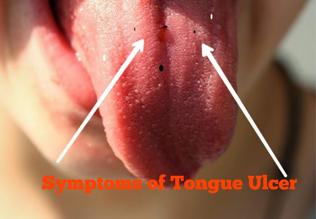 How to prevent and cure of Tongue Ulcer How to prevent and cure of Tongue Ulcer