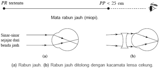 Biology Page Cacat Mata Kelainan Mata