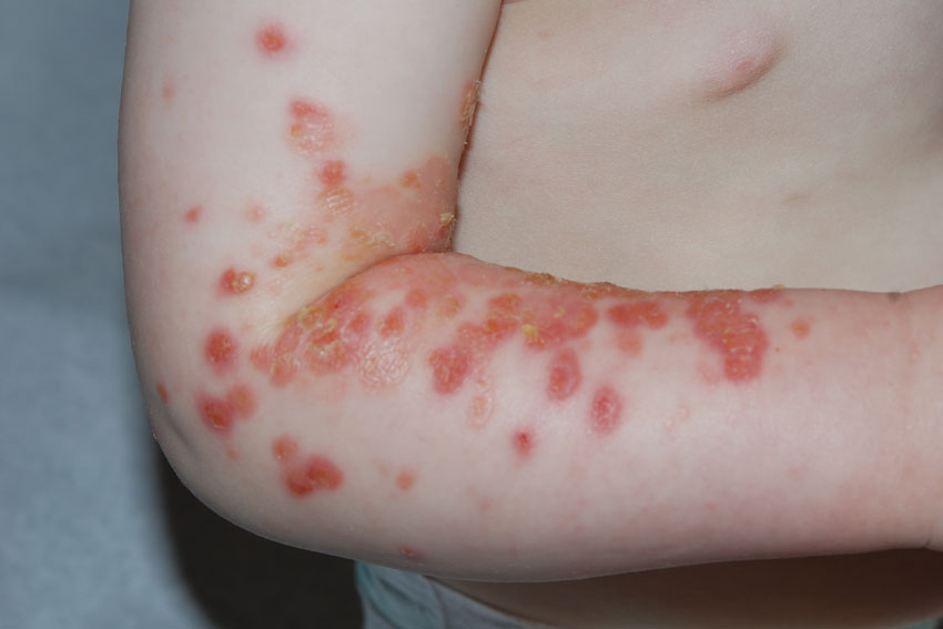 Impetigo - Dermnet: Dermatology Pictures - Skin Disease ...