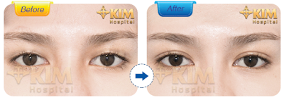 Khách hàng thực hiện thẩm mỹ mắt Hàn Quốc tại KIM Hospital