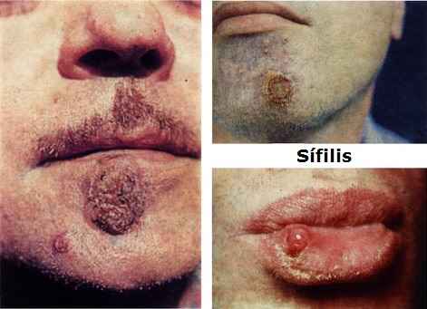 Sífilis enfermedad