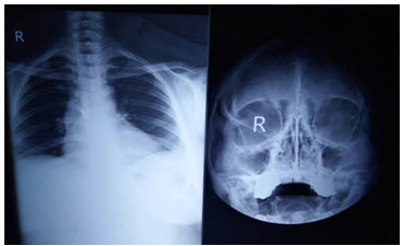Chest X- ray of the patient with mediastinial adenopathy