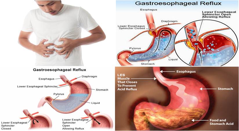 5 Cara Ampuh Atasi GERD Secara Alami: Raih Kembali Kesenangan Makan!