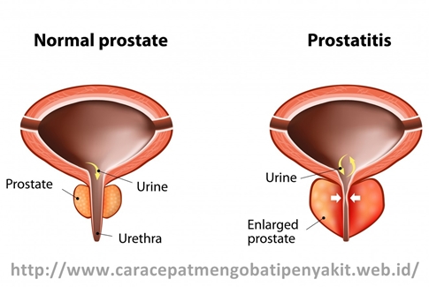 Cara Cepat Mengobati Radang Prostat dengan Ampuh Cara Cepat Mengobati Radang Prostat dengan Ampuh