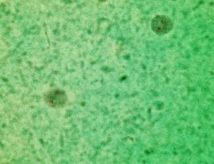 paraziták dientamoeba fragilis blastocystis hominis