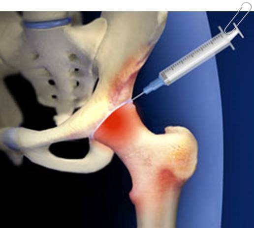 tratament articular pozitiv se poate vindeca artroza șoldului