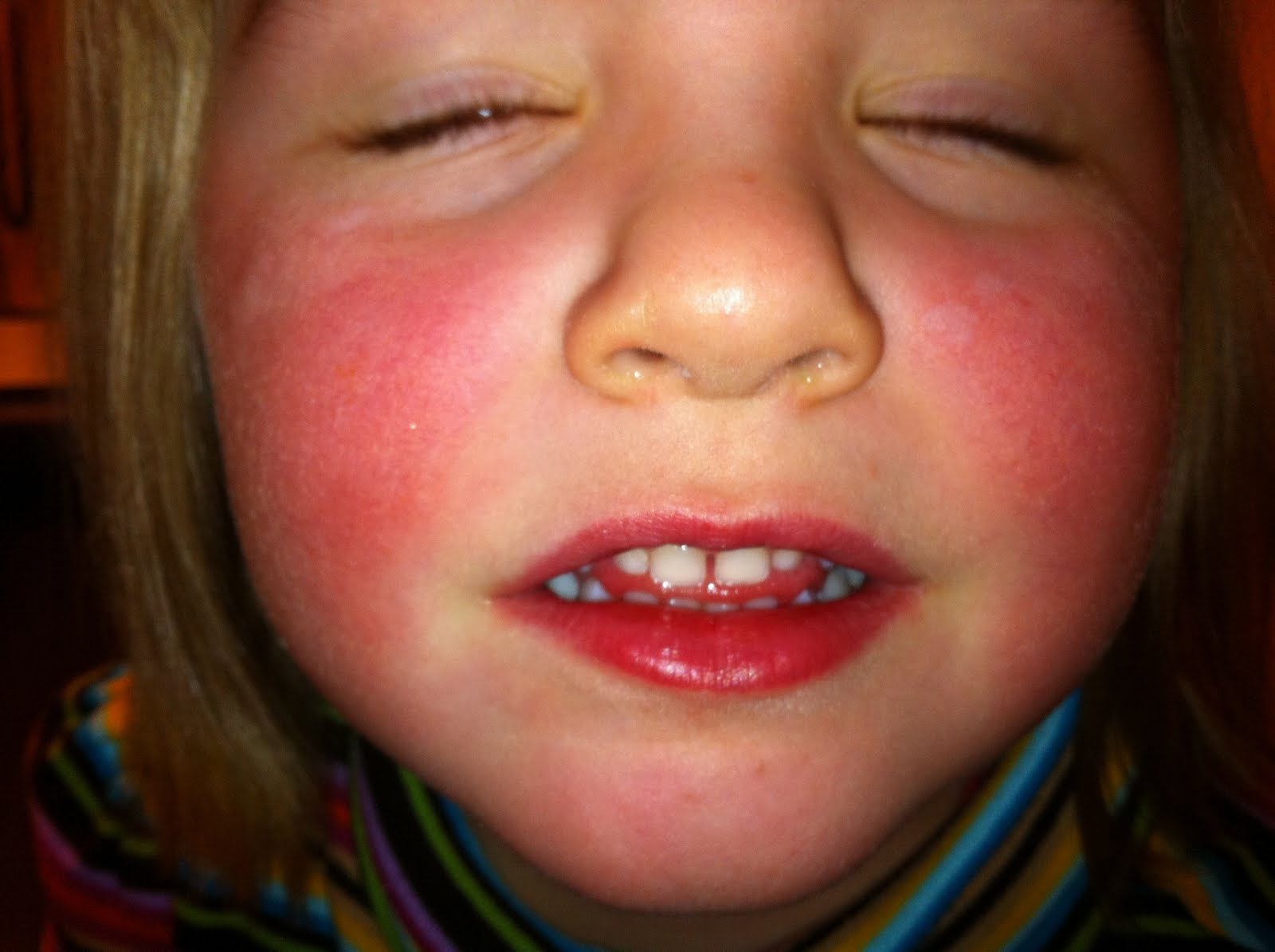 toddler facial rashes