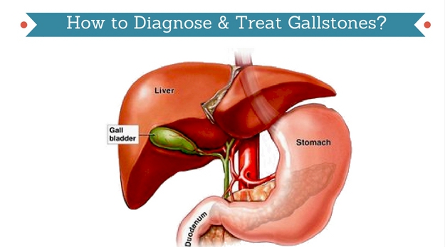 How to Diagnose & Treat Gallstones