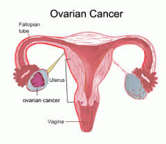 signs and symptoms of ovarian cancer