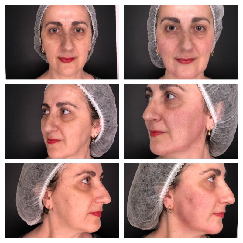 Raqueleita Blog: Eliminando las Ojeras y Redibujando el Óvalo Facial en