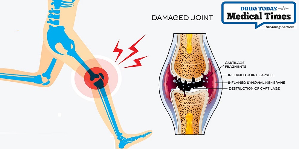 Drug Today Medical Times What is the best way to treat knee pain Easy