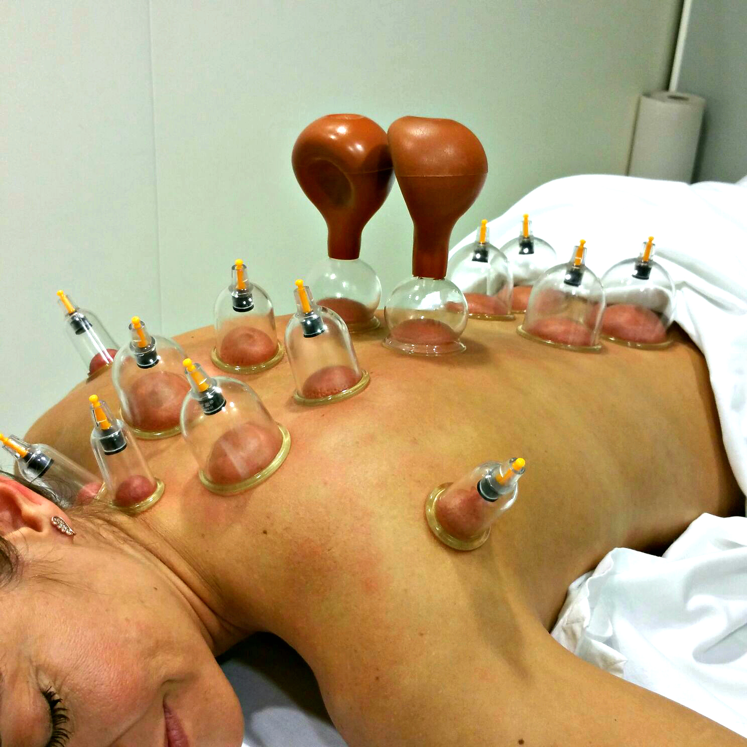 Fisioterapia Ventosaterapia Para Celulitis Ventosa Celulitis