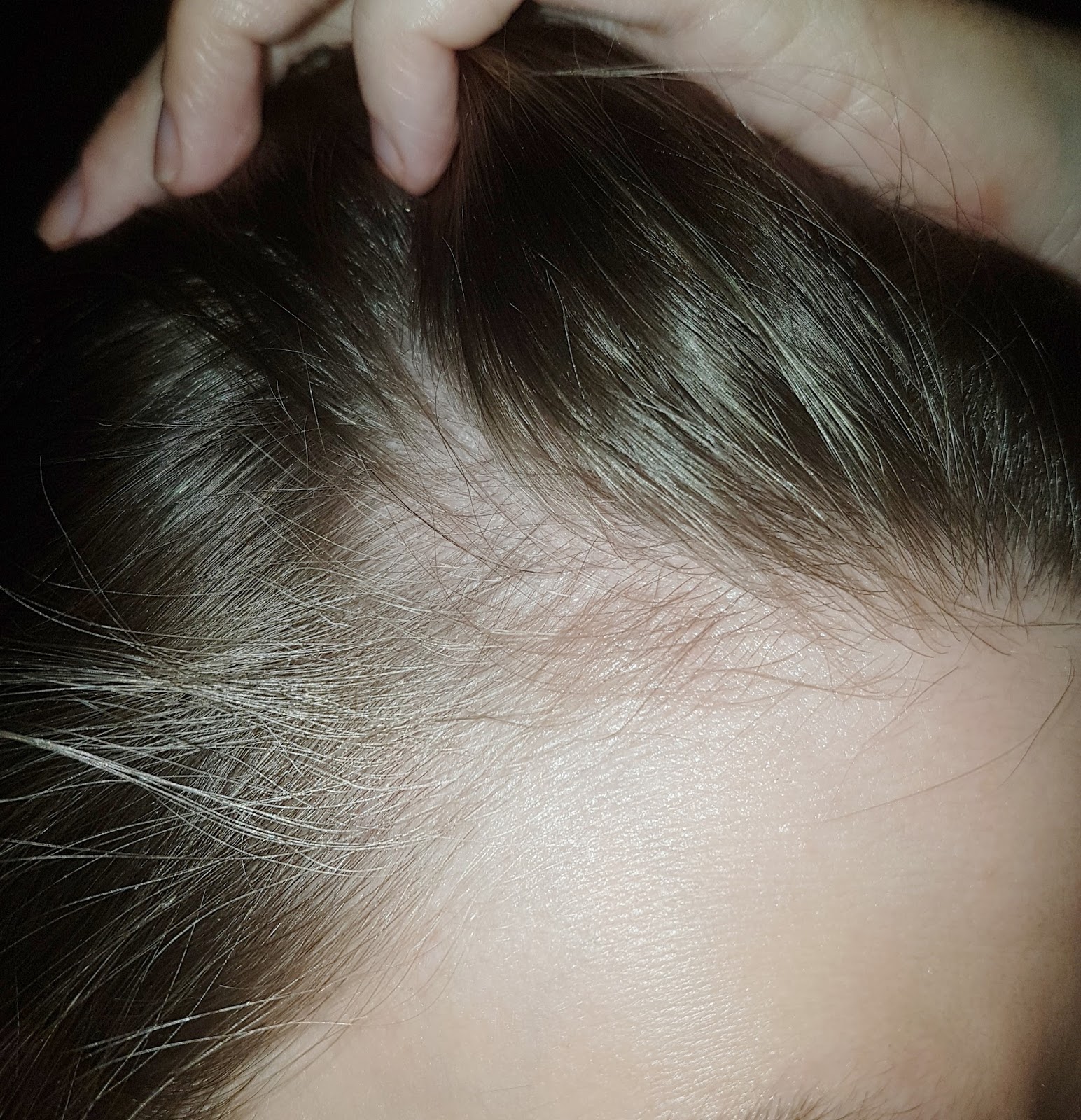 Lost in the Oyster Scalp Eczema