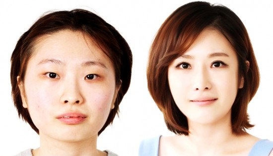 Hình ảnh trước và sau khi phẫu thuật thẩm mỹ Hàn Quốc