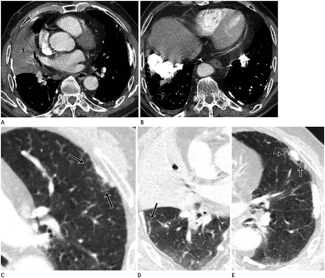 ClinicalRadiological Markers of Exposure to Asbestos Mesothelioma