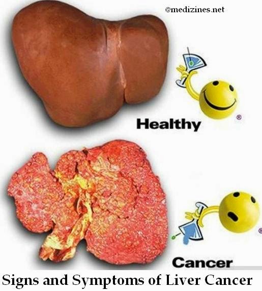 Liver Cancer Signs and Symptoms of Liver Cancer