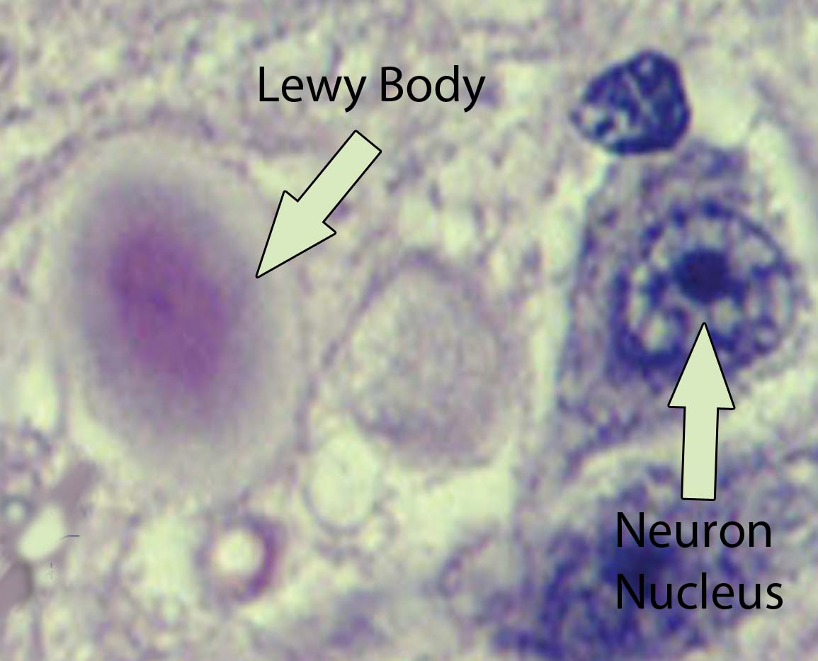 Brain today lewy body dementia