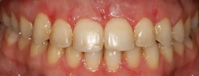 crown lengthening after photo