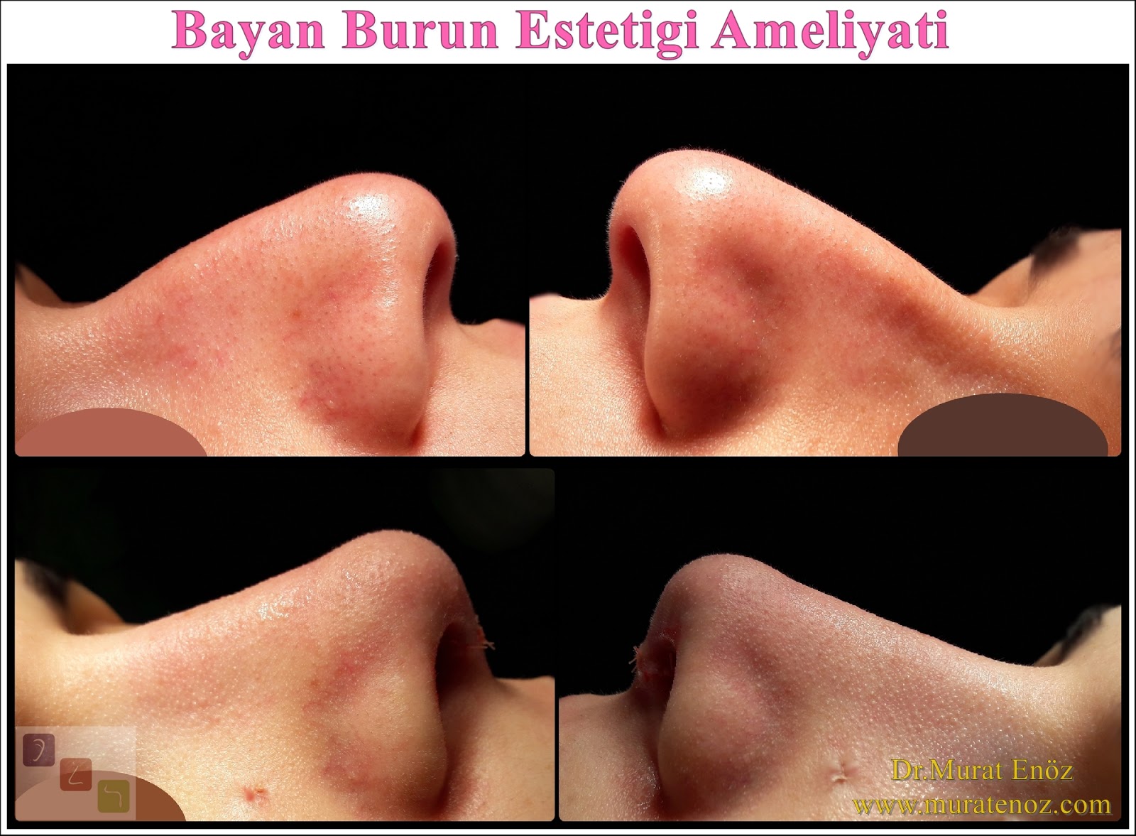 Bayan Burun Estetiği Ameliyatı