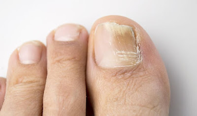 Top 10 Home Remedies To Get Rid Of Toenail Fungus Fast Top 10 Home Remedies To Get Rid Of Toenail Fungus Fast