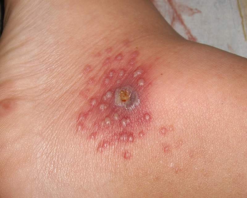 How to Treat an Infected Blister - Buzzle