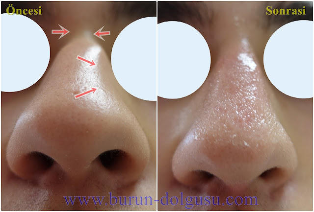 Burun Kökü Dolgusu - Burun Dolgusu - Dolguyla Burun estetiği - Non-surgical Nose Job In Istanbul - Dolgu İle Burun Ucu Kaldırma - Burun Ucu Dolgusu - Burun Dolgusu Fiyatı - Ameliyatsız Burun Estetiği - Burun Dolgusu Fiyatları - Dolgu İle Burun Kaldırma - Dolgu İle Burun Düzeltme