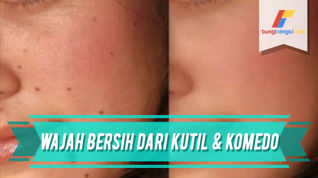Cara Ampuh Menghilangkan Kutil, Komedo Jahat dan Bintik Hitam dari Wajah Cara Ampuh Menghilangkan Kutil, Komedo Jahat dan Bintik Hitam dari Wajah