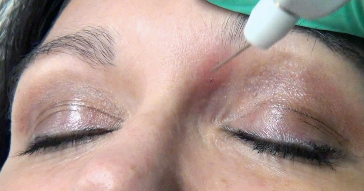 Plexr Plasma Eye Lift in Dubai & Abu Dhabi & Sharjah Best Health & Beauty Tips Write For Us