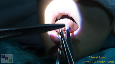 Lingual frenectomy - Tongue tie release surgery - Bloodless and bladeless lingual frenectomy