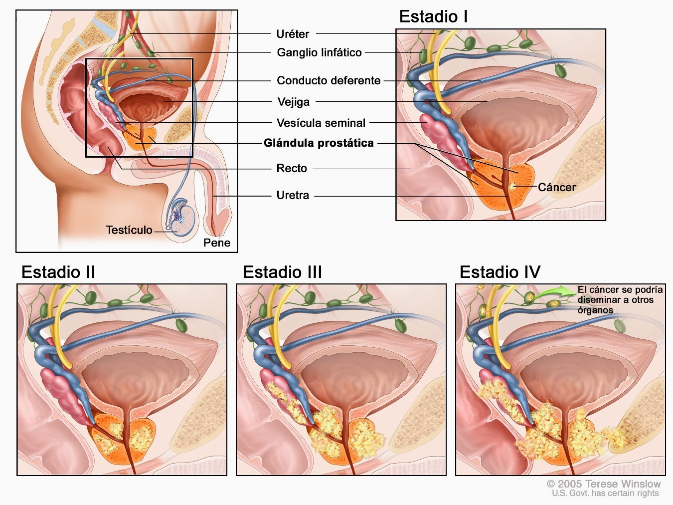 cancer de prostata estado terminal)