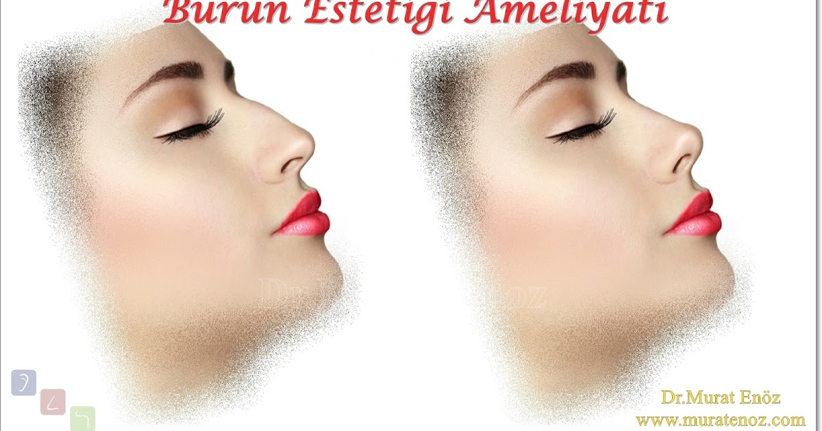 Devlet Hastanelerinde Burun Estetigi Fiyatlari 2020