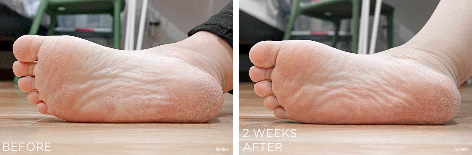 lavlilacs The Chemistry Brand Heel Chemistry before after