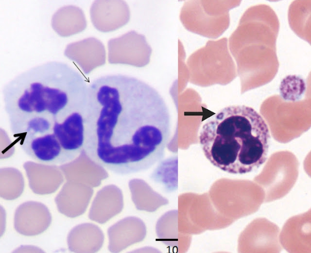 Anaplasmosis: Causes, symptoms, treatments, and Prevention - Healthintimation Anaplasmosis: Causes, symptoms, treatments, and Prevention - Healthintimation