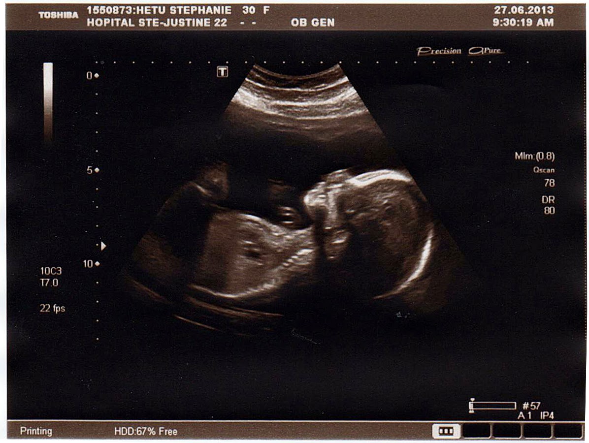 Journal d'une maman FLP Échographies