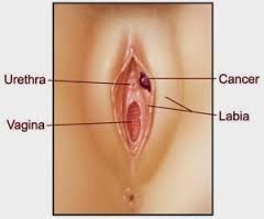 Cara Menyembuhkan Kanker Vulva