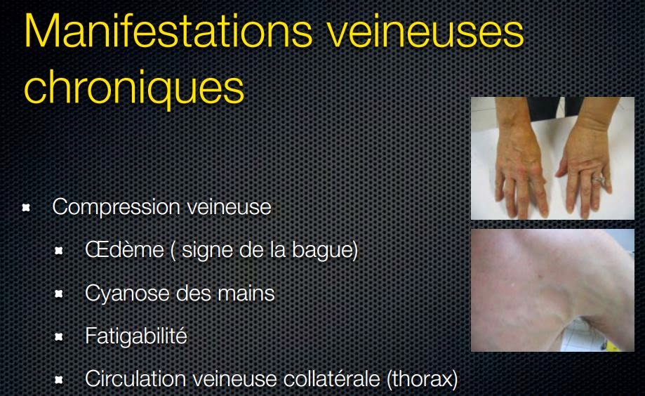 Un médecin du sport vous informe Syndrome du défilé thoracobrachial (SDTB)