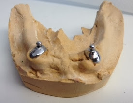 Próteses dentárias sobre implantes