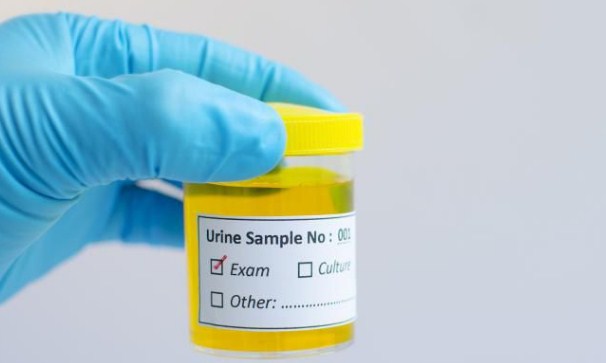 11 Warna Urine Yang Bisa Jelaskan Kesehatan Anda