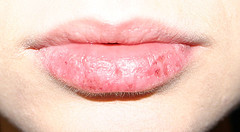 My Daily Life: Cure Dry Flaky Lips Problems